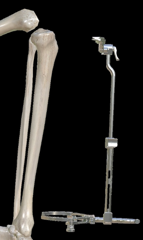Original Maxx Freedom R10, page 10 · EM tibial guide